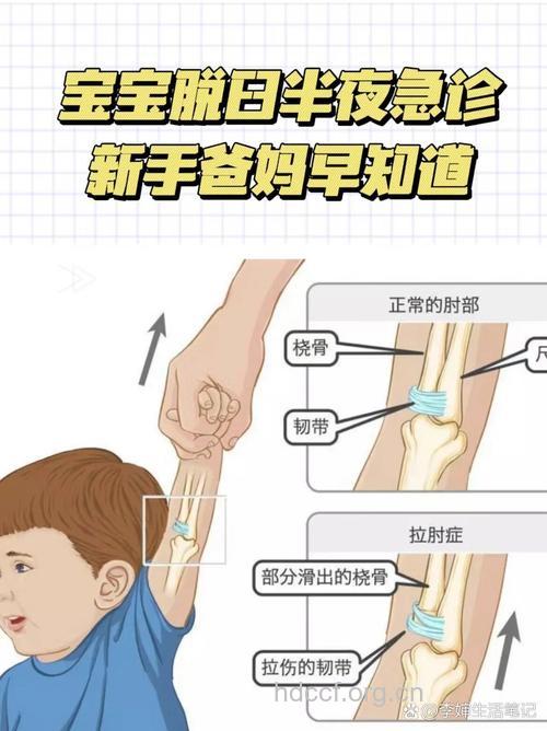 牵手牵出关节脱位