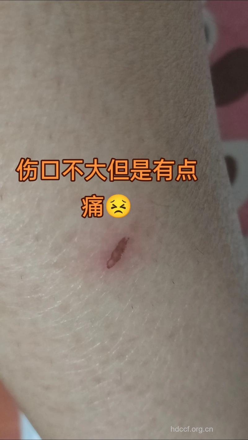 伤口难愈合 蜂蜜芦荟愈合伤口有一套