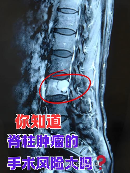 骨头上的一大隐患　颈椎肿瘤