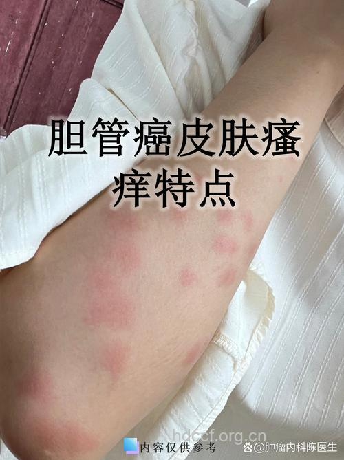 皮肤瘙痒也可能是癌症