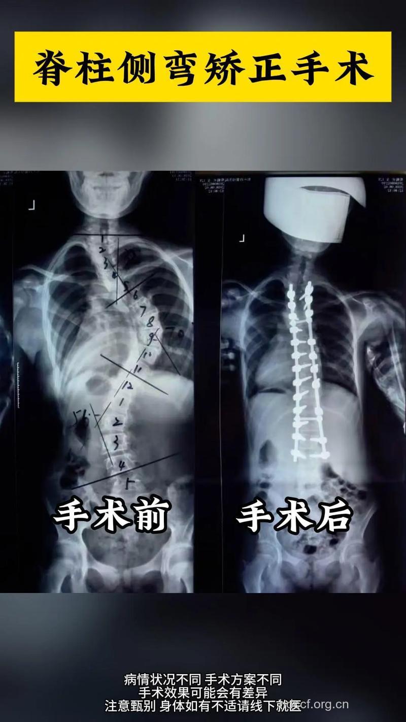 7岁脊柱侧弯患儿即将手术