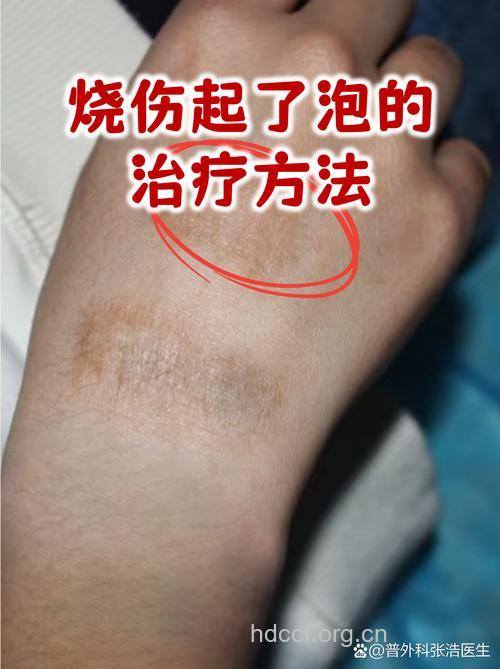 热力烧伤有什么临床表现