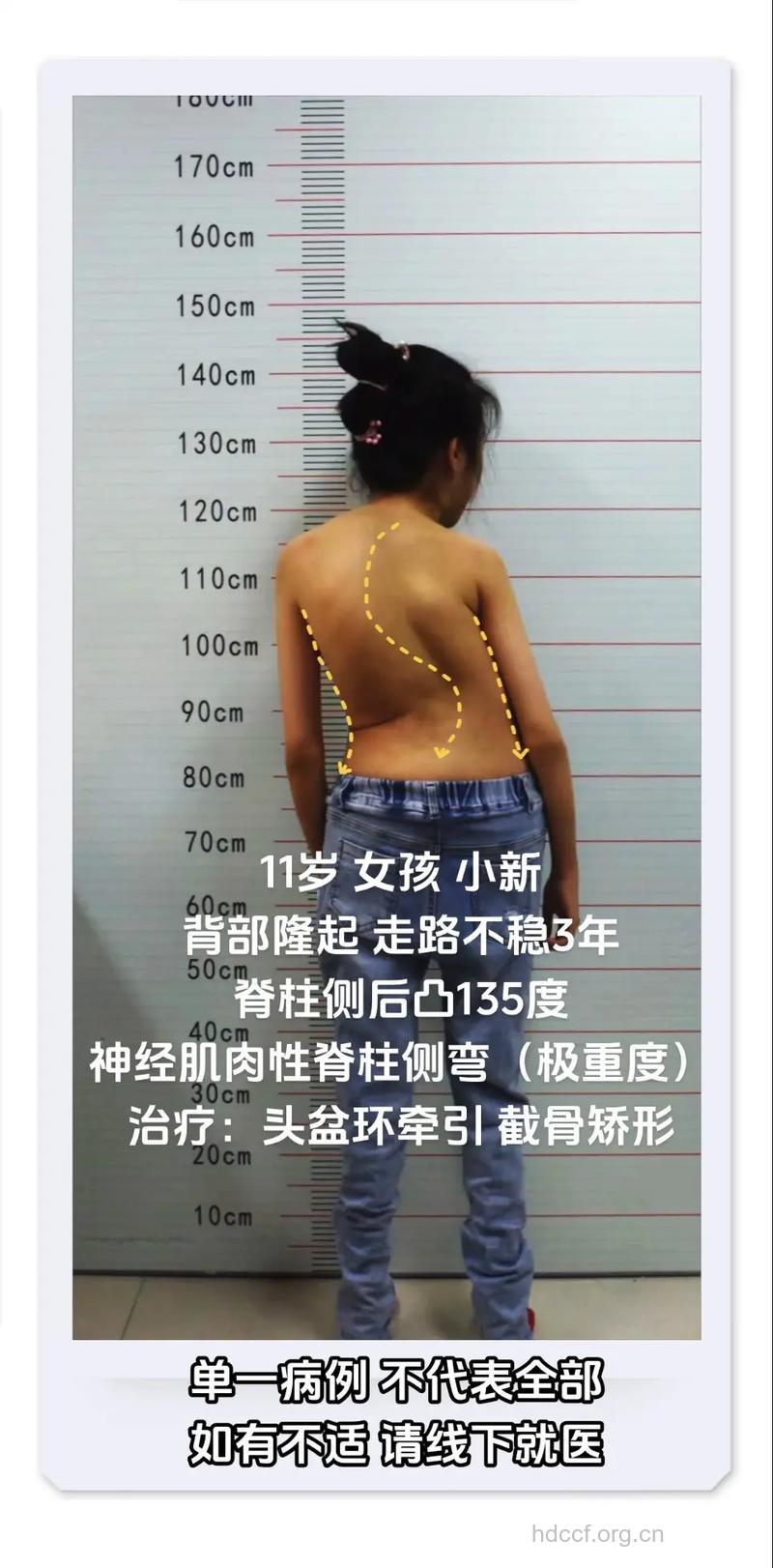 低龄儿脊柱侧弯不治可能死亡