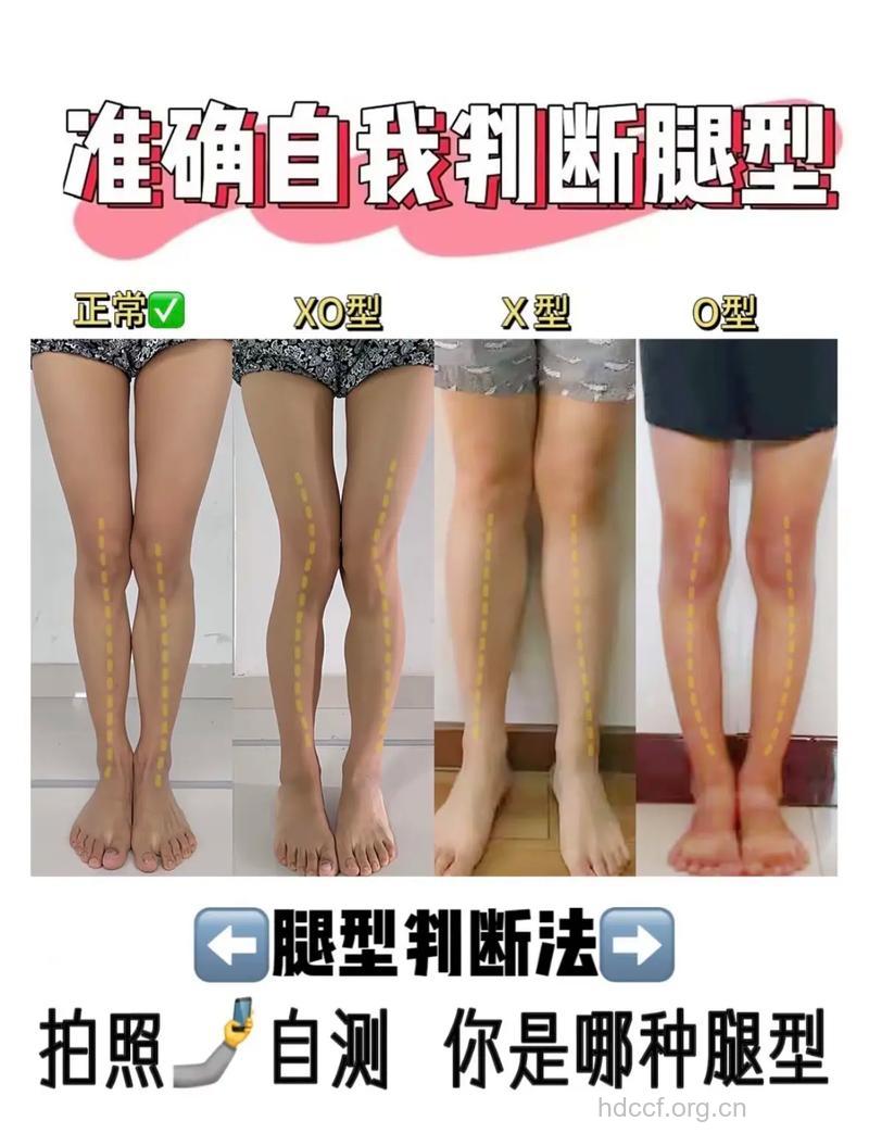O型腿对腿部有哪些影响