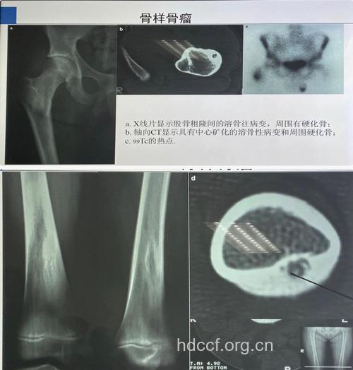 骨样骨瘤与其它骨病的鉴别