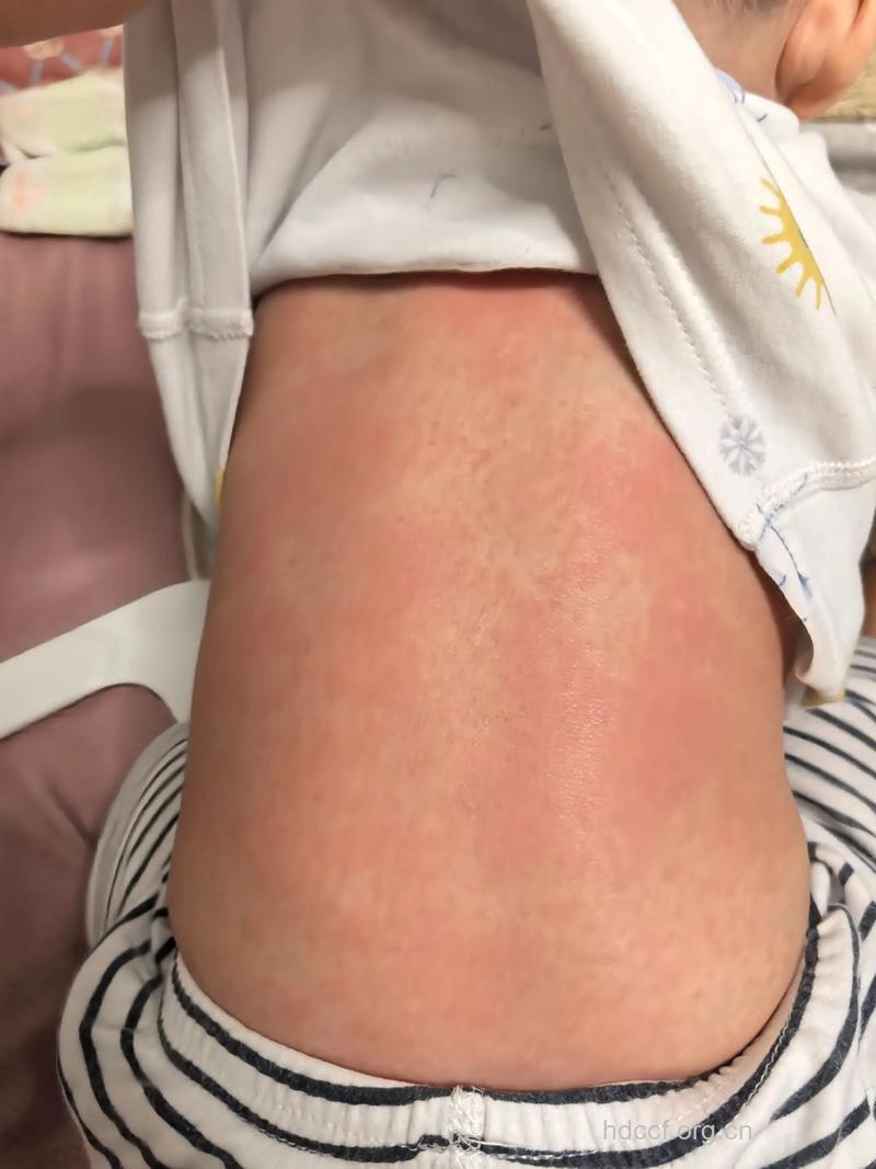 为何乙肝疫苗过敏