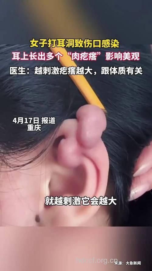 惊！打耳洞也能感染乙肝病毒