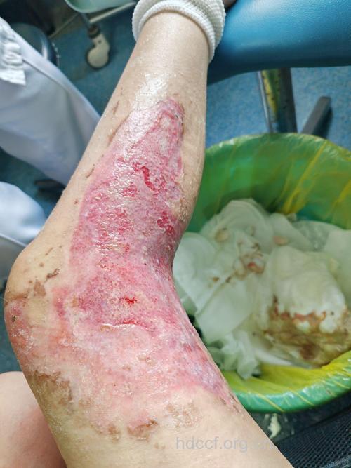 烧伤感染有哪些临床表现