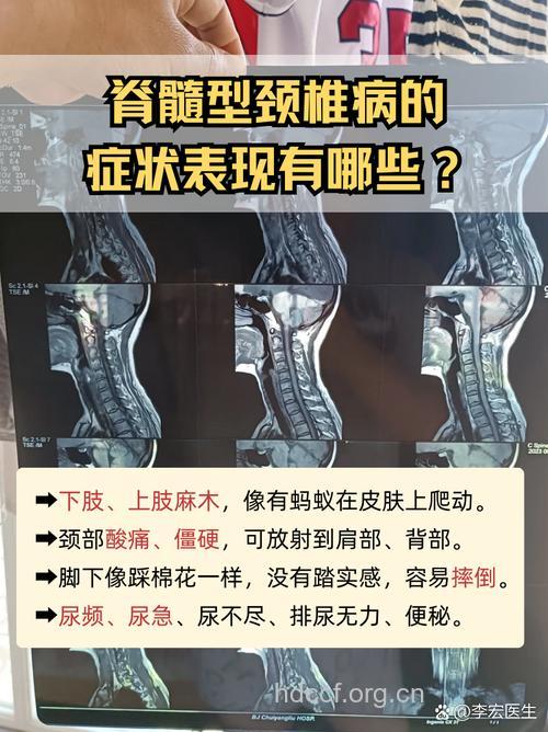脊髓型颈椎病的常见症状