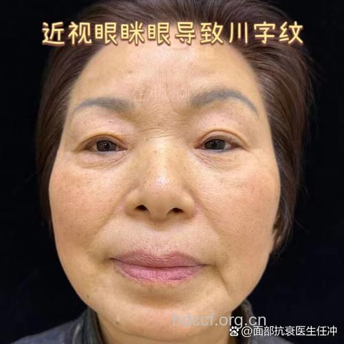 从眉毛状态看颈椎病症状