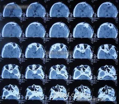 车祸头部外伤有哪些处理原则