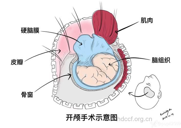 怎么正确应对头部手术