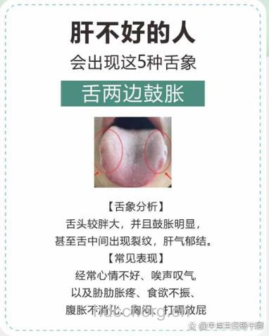 乙肝大三阳为什么会口干舌燥