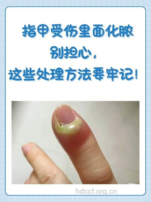 指甲挤伤有哪些处理方法