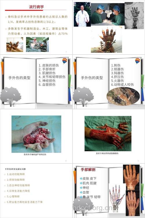 手外伤常见的8种类型