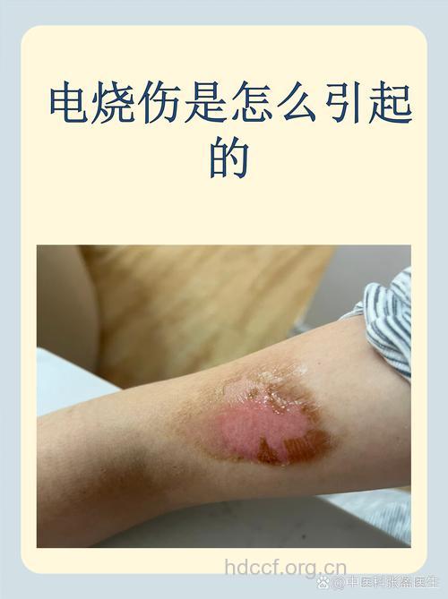 电烧伤和普通烧伤有什么区别