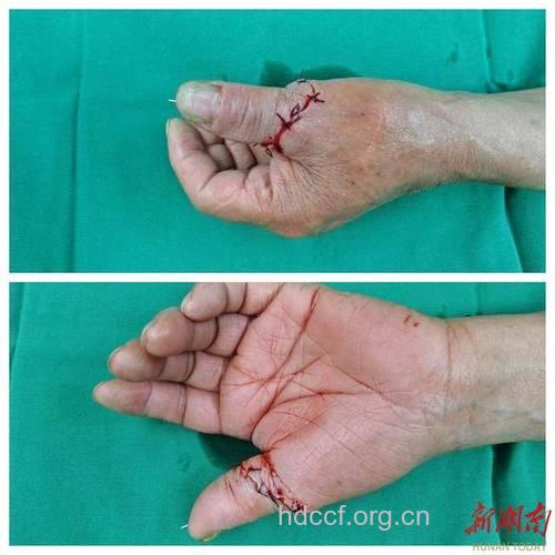 断指再植西医能治疗吗?有什么方法呢?