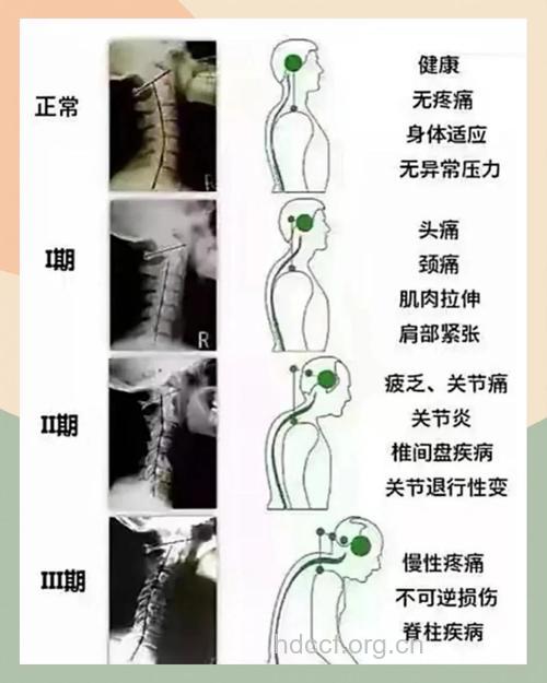 颈椎病的症状你知道多少