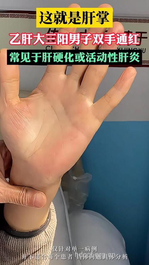 大三阳为什么会双手浮肿