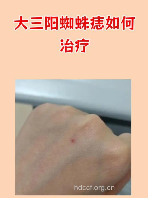 大三阳为什么会导致蜘蛛痣