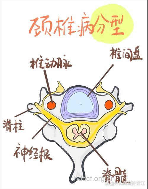 颈椎病有什么发病机制