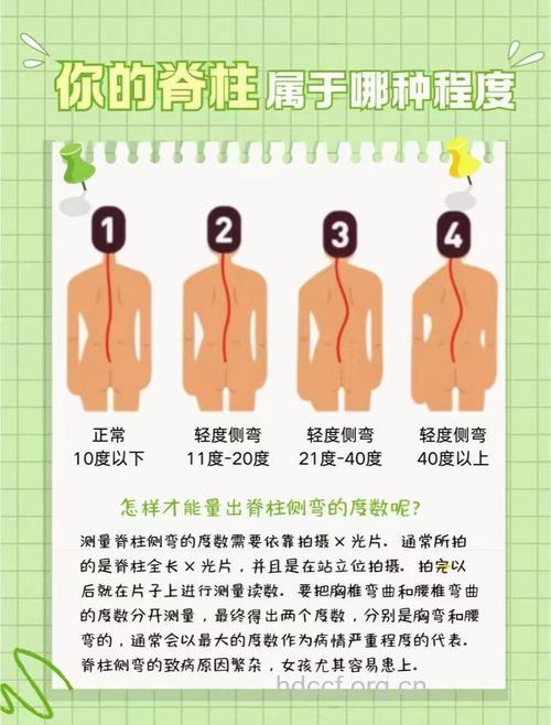 脊柱侧弯有什么危害