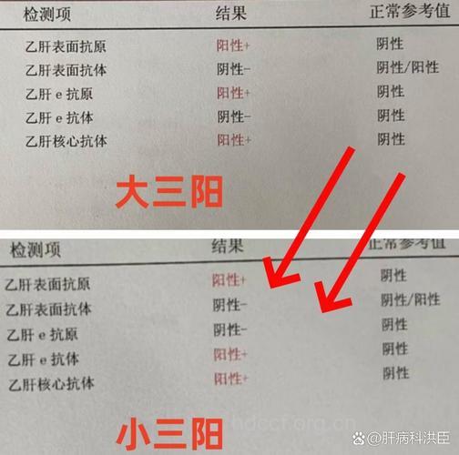 乙肝小三阳和大三阳哪里不同