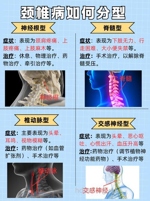 关于颈椎病有哪些类型