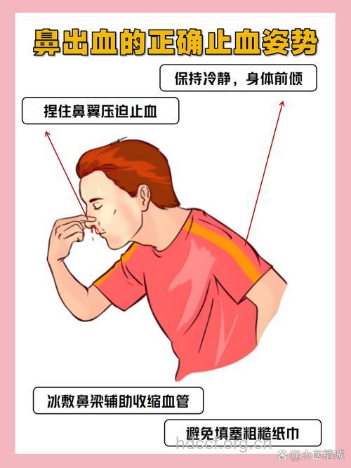 流鼻血塞纸没用 试试这几种方法