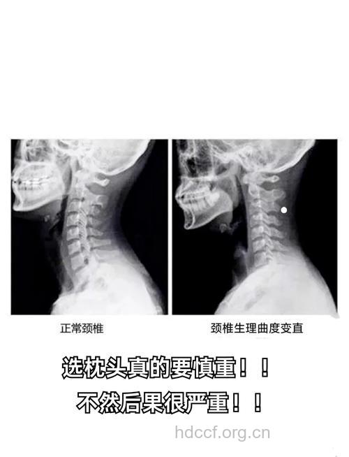 颈椎病的假象有哪些