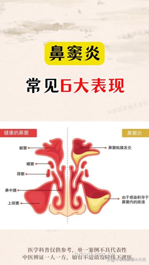 鼻窦炎的七大症状