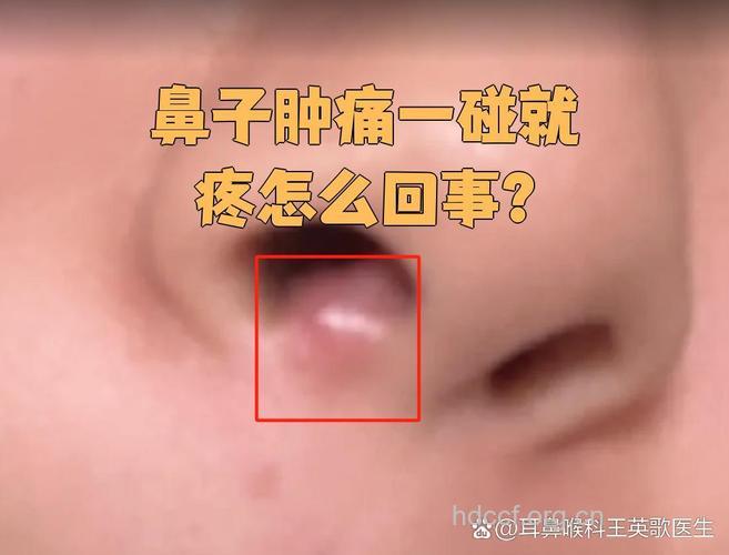 鼻子一碰就痛可能是鼻前庭炎