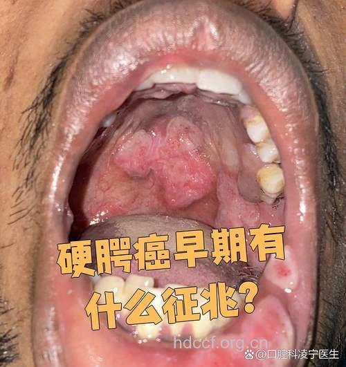 咽喉癌早期症状有哪些