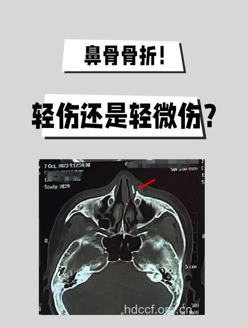 鼻骨骨折有哪些临床表现