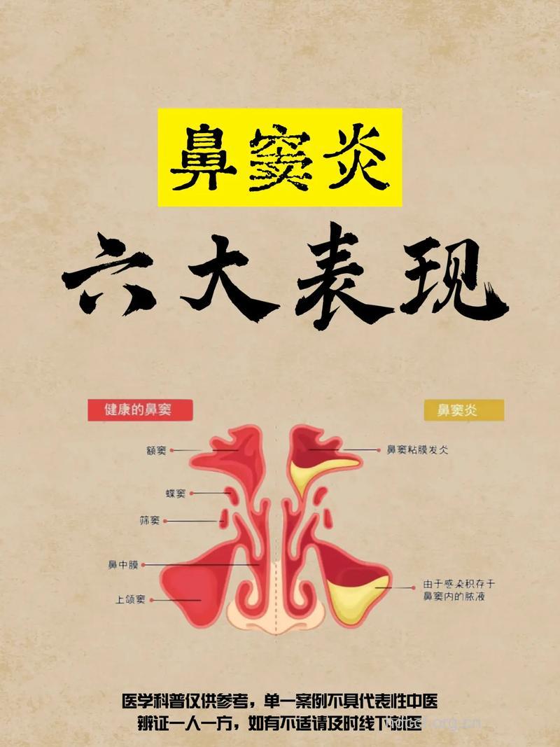 鼻窦炎常见症状有哪些