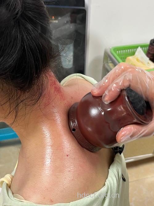 过敏性鼻炎的拔罐疗法