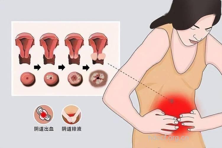 阴道癌的常见症状有哪些
