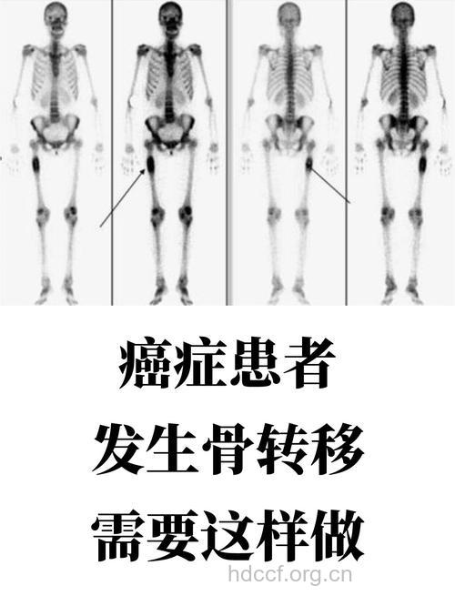 什么是恶性肿瘤骨转移