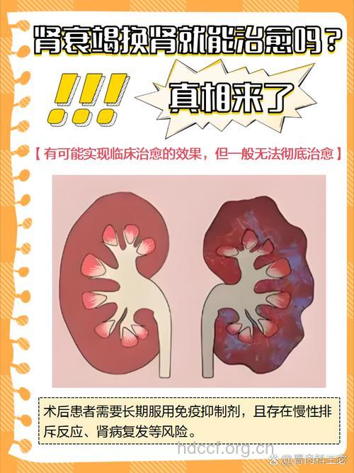 肾病换肾就能治愈？盘点4种肾病治疗误区