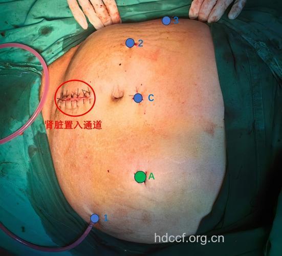 上海首例肾癌供肾移植手术成功实施