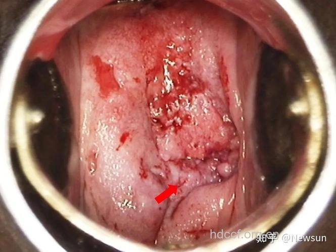 常见的宫颈癌症状有哪些