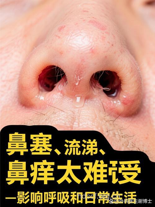 常见的药物性鼻炎的症状是什么