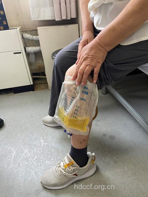 肾病患者挂着尿袋生活30年