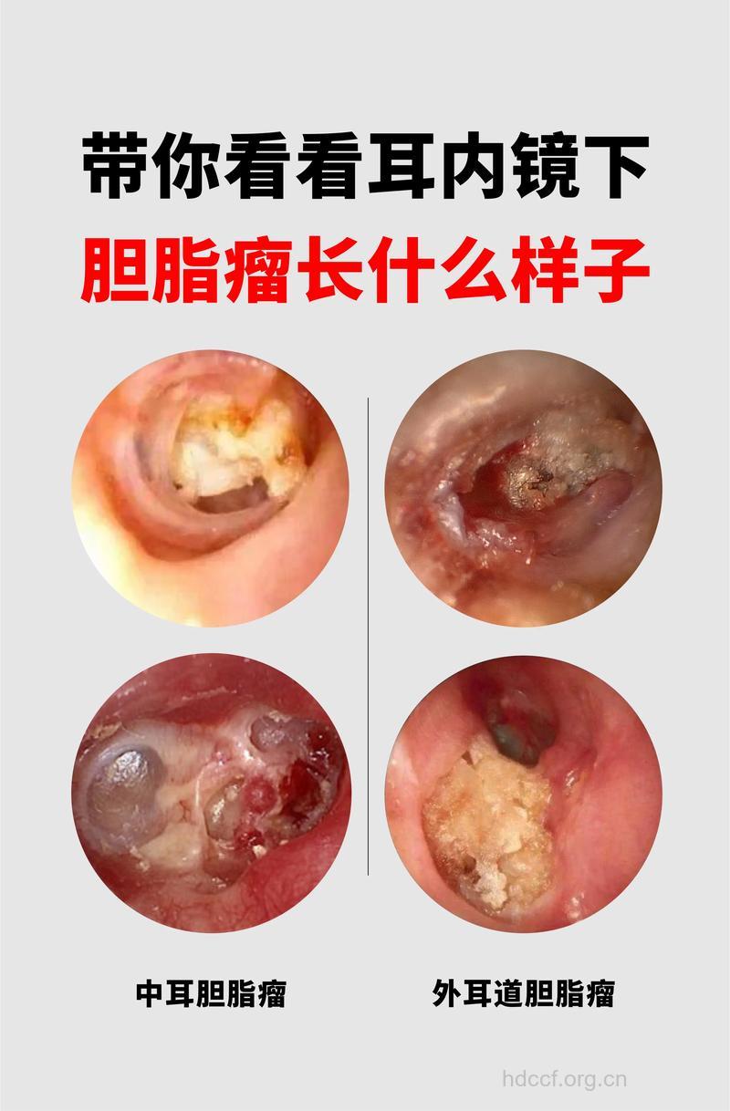耳朵里会长什么肿瘤