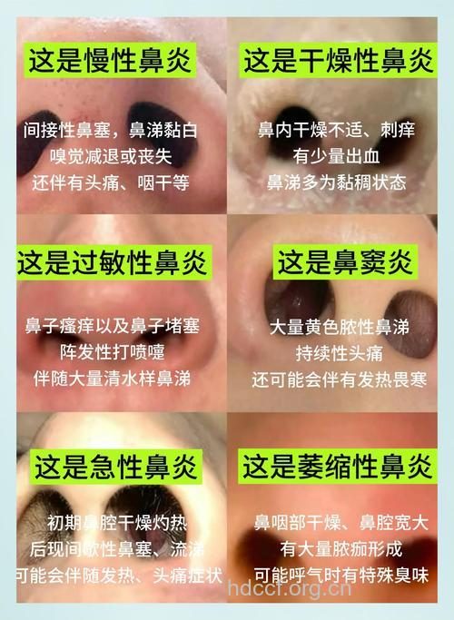 慢性鼻炎的症状及治疗方法