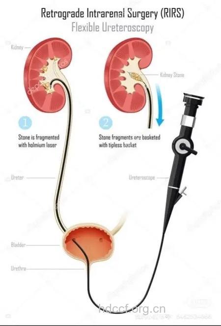 对付肾结石 软镜手术越来越受欢迎