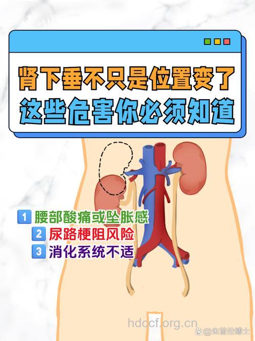 肾下垂并不是肾炎 无需谈肾色变