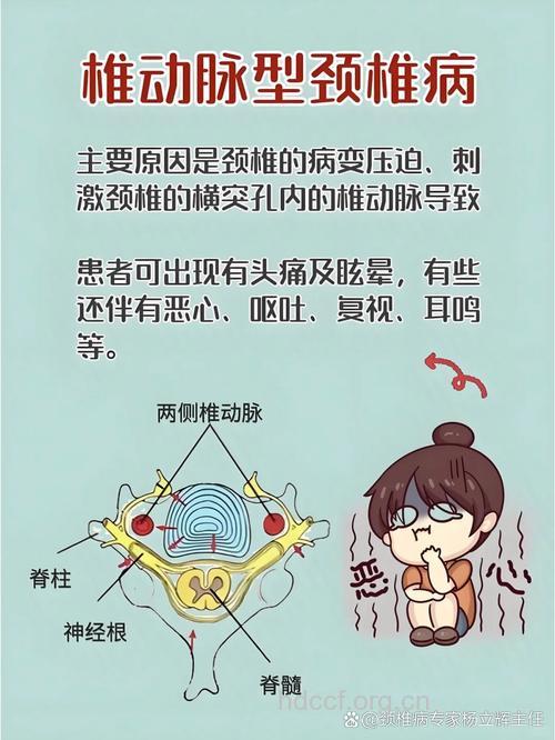 椎动脉型颈椎病