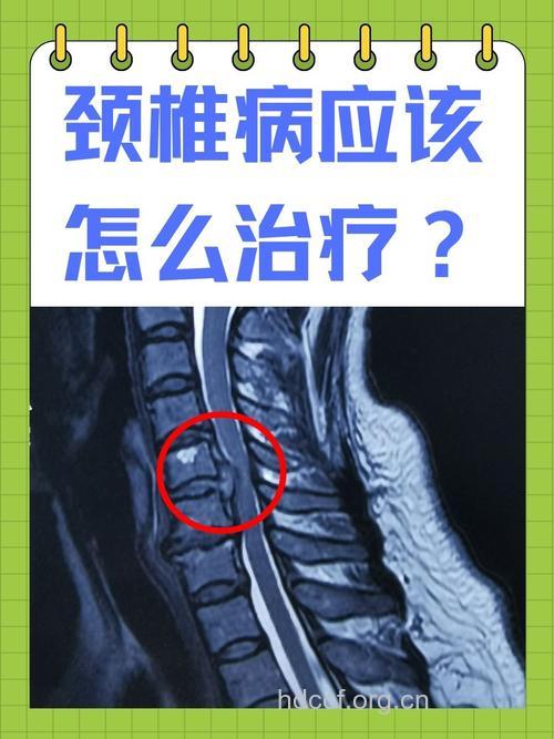 颈椎病的确诊为何那么难