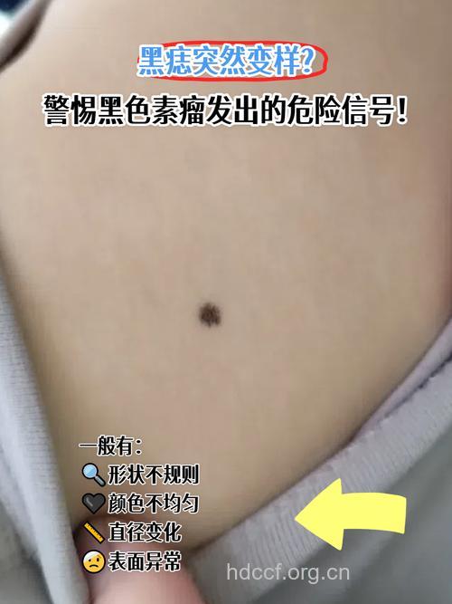 小心黑痣恶化成黑色素瘤